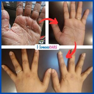 Palmar_Psoriasis