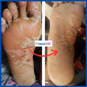 Palmo_Plantar_Psoriasis