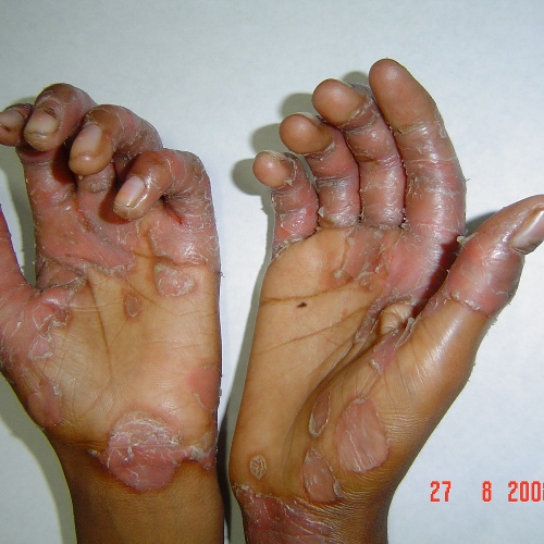 Palmoplantar psoriasis