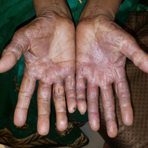 Palmoplantar_psoriasis_treatment_with_homeopathy