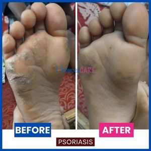 Plantar_psoriasis_1