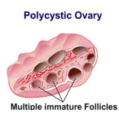 .Polycystic_Ovarian_Disease