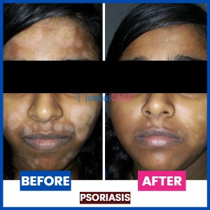 Psoriasis