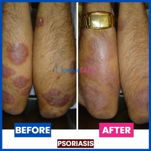 Psoriasis_Hands