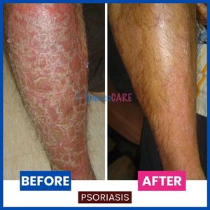 Psoriasis_legs