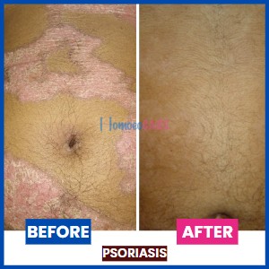 Psoriasis_on_Stomach