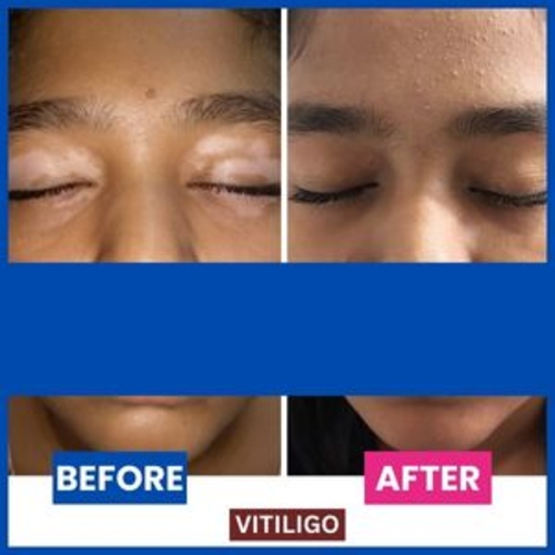 Successful_-homeopathic-treatment-of-vitiligo