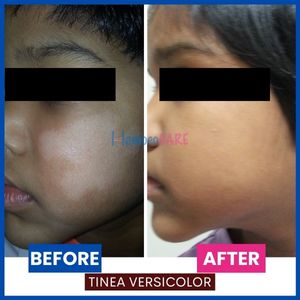 Tinea_Versicolor