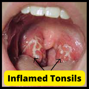 Tosillitis