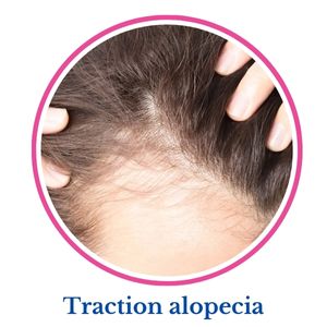 Traction alopecia