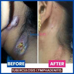 Tuberculosis_Lymphadenitis_