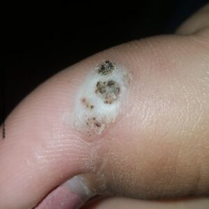 Viral warts homeopathic treatment