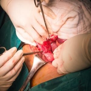 appendectomy