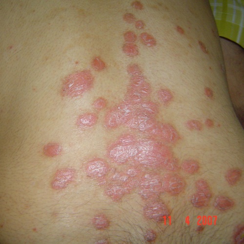 plaque psoriasis