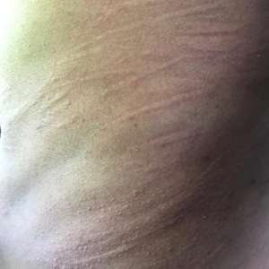 urticaria