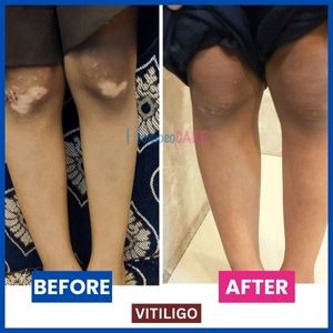 vitiligo_on_leg