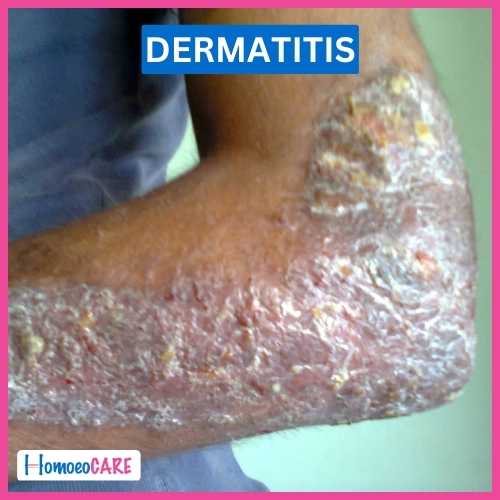 Infective Dermatitis