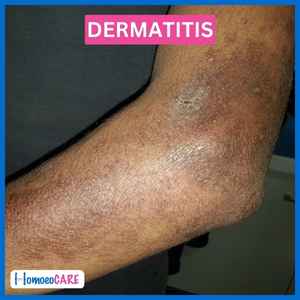 1678366222.dermatitis_after