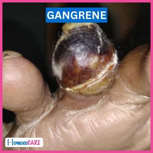 Gangrene