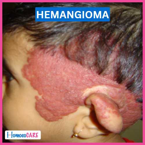 hemangioma