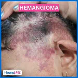 1678366565.hemangioma_after