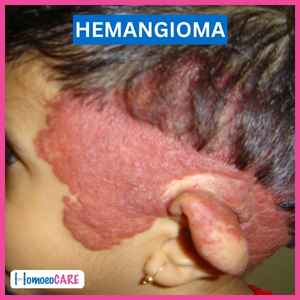 1678366565.hemangioma_before