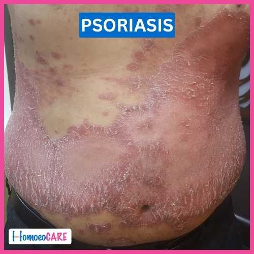 Psoriasis