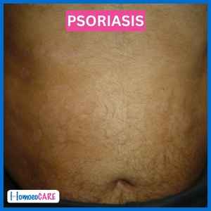 1678366836.psoriasis_after