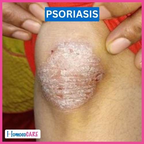 Psoriasis