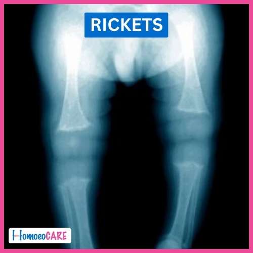 Rickets