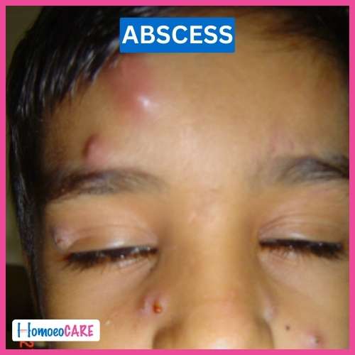 Case study of Successful Treatment of Recurrent Abscess by Homeopathy