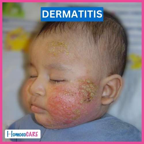 Atopic Dermatitis