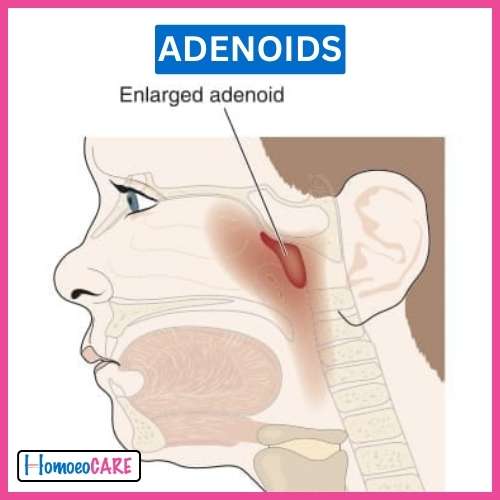 Adenoids