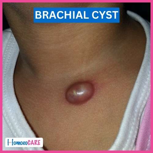 Branchial Cyst by Homeopathy