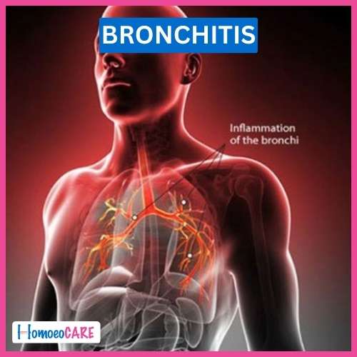 Bronchitis