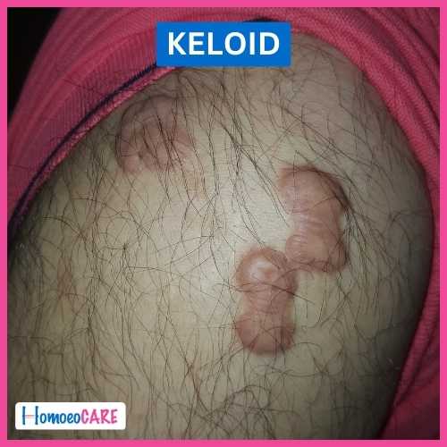 Keloid