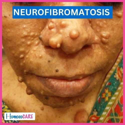 Neurofibromatosis