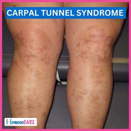 Carpal tunnel syndrome with Livedo Reticularis