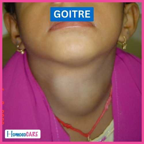 Goitre