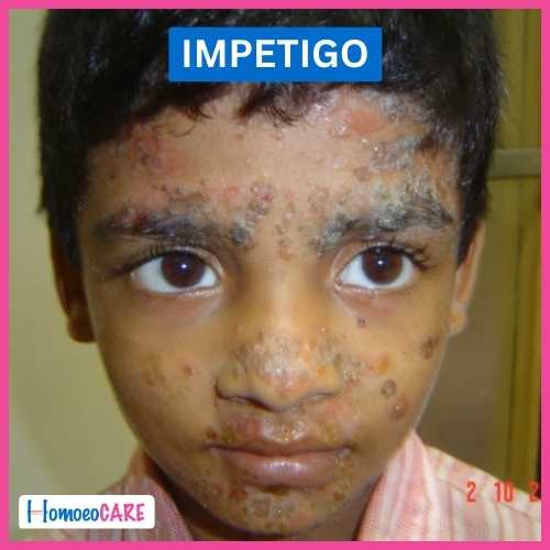 Impetigo