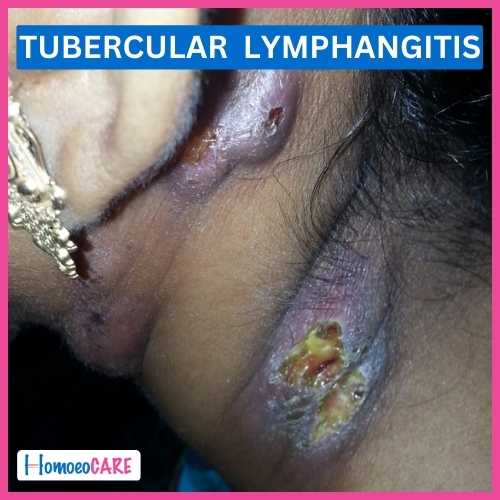 Tubercular Lymphangitis