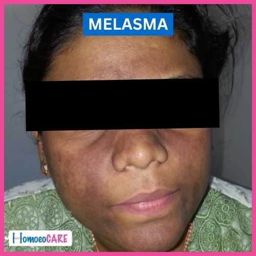 Melasma