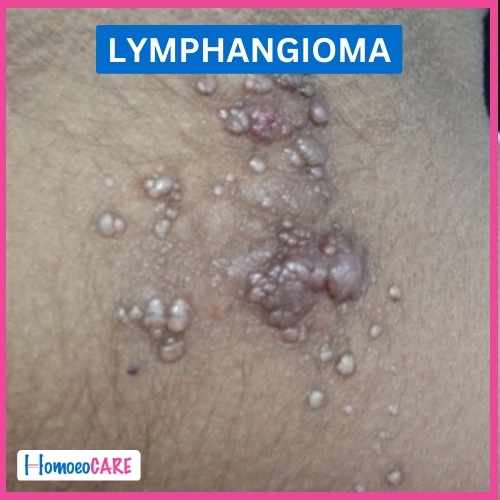 Lymphangioma