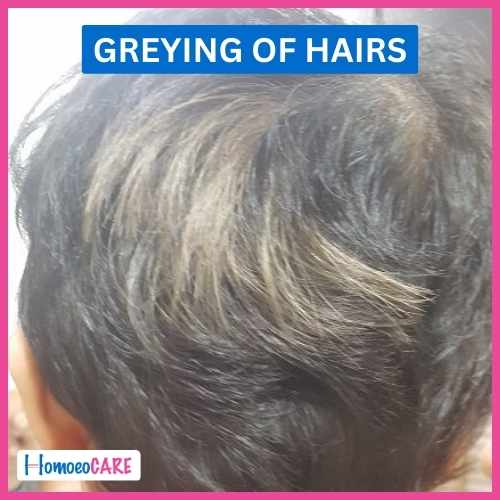 Greying of hairs