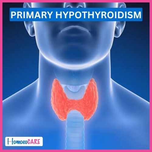 Hypothyroidism by Homeopathy