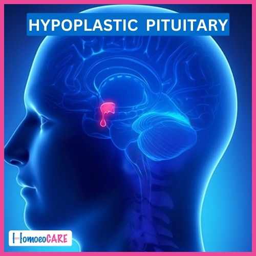 Hypoplastic Pituitary