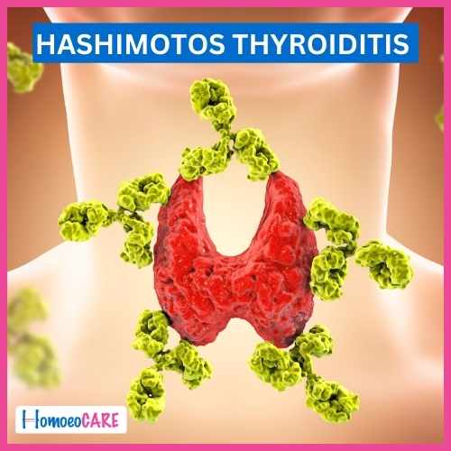 Hashimotos Thyroiditis