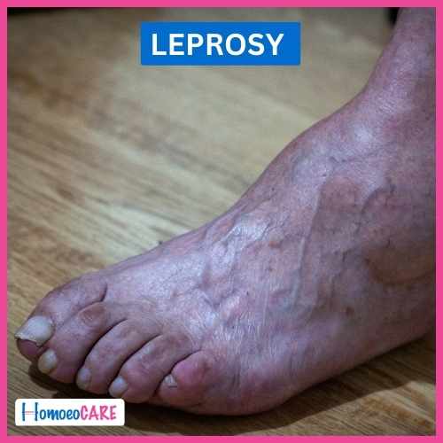 Leprosy