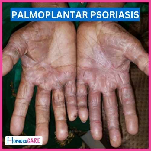 Palmoplantar Psoriasis