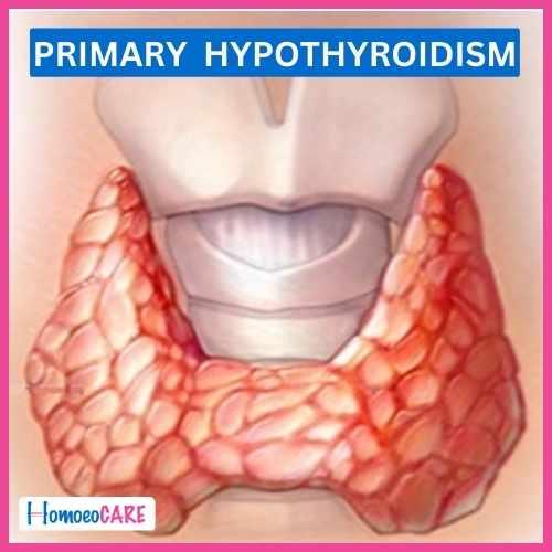 Hypothyroidism